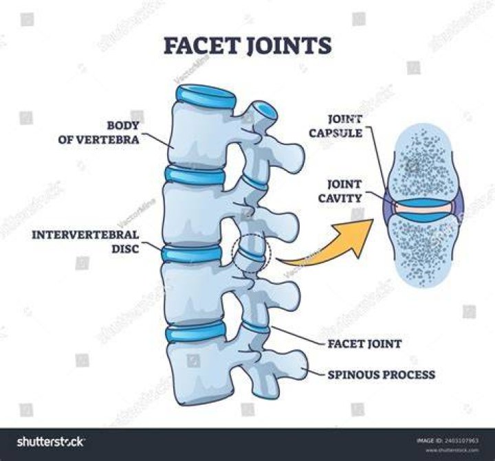 A Comprehensive Guide To Facet Hypertrophy: Definition And Causes