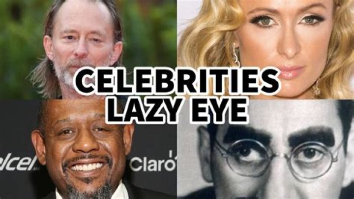 Exceptional Actors With Enchanting Lazy Eyes