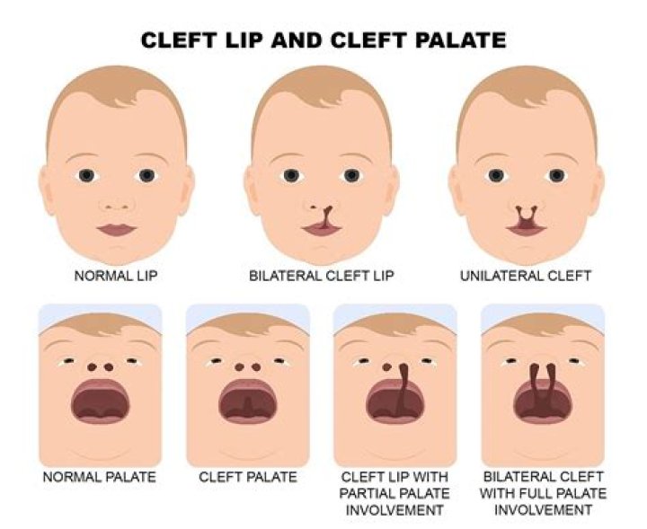 Famous Faces And The Inspiring Stories Of Cleft Palate