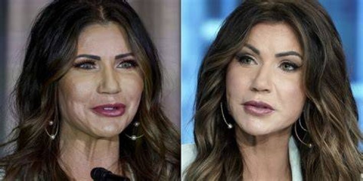 Kristi Noem's Plastic Surgery Journey