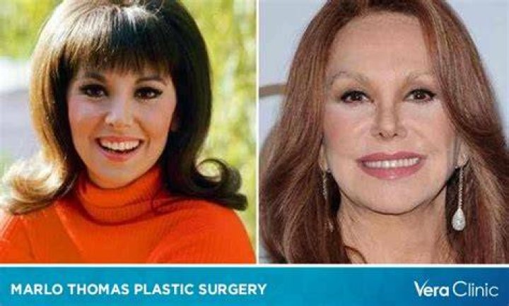 Marlo Thomas Plastic Surgery Before And After Transformation