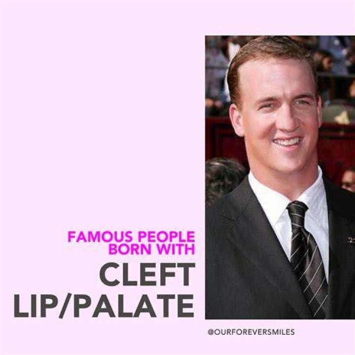 Read Stories About Famous Cleft Palate Actors