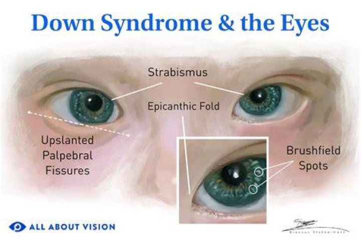 Shining A Light On Down Syndrome