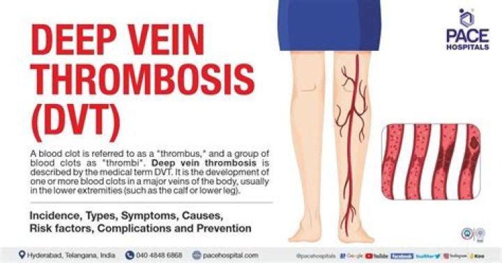 The Essential Guide To ICD 10 Codes For Deep Vein Thrombosis (DVT)