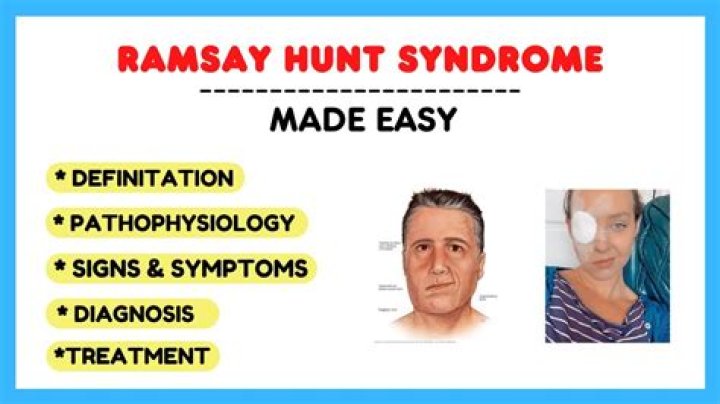 Understanding Ramsay Hunt Syndrome: Causes, Symptoms And Treatment