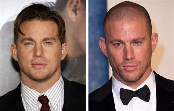 Young Balding Celebrities